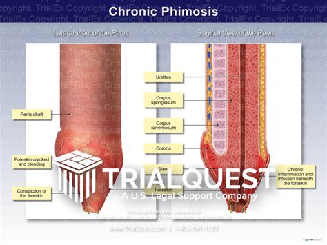 fimosis foto|Phimosis Photos Science Photo Library